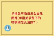 手指关节吻痕怎么去除图片(手指关节留下的吻痕该怎么消除？)