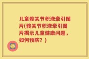 儿童髋关节积液牵引图片(髋关节积液牵引图片揭示儿童健康问题，如何预防？)