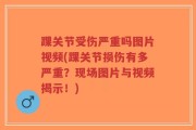 踝关节受伤严重吗图片视频(踝关节损伤有多严重？现场图片与视频揭示！)