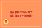 肘关节钢钉图(肘关节钢钉固定手术示意图)