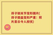 孩子腿关节变形图片(孩子膝盖变形严重：照片显示令人担忧)