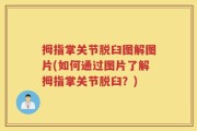 拇指掌关节脱臼图解图片(如何通过图片了解拇指掌关节脱臼？)