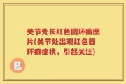 关节处长红色圆环癣图片(关节处出现红色圆环癣症状，引起关注)