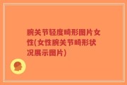 腕关节轻度畸形图片女性(女性腕关节畸形状况展示图片)