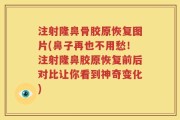注射隆鼻骨胶原恢复图片(鼻子再也不用愁！注射隆鼻胶原恢复前后对比让你看到神奇变化)