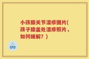 小孩膝关节湿疹图片(孩子膝盖处湿疹照片，如何缓解？)