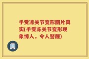 手受凉关节变形图片真实(手受冻关节变形现象惊人，令人警醒)