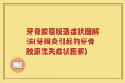 牙骨胶原脱落症状图解法(牙周炎引起的牙骨胶原流失症状图解)