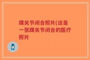 踝关节闭合照片(这是一张踝关节闭合的医疗照片