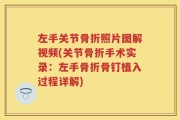 左手关节骨折照片图解视频(关节骨折手术实录：左手骨折骨钉植入过程详解)