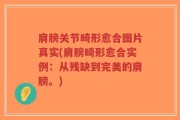 肩膀关节畸形愈合图片真实(肩膀畸形愈合实例：从残缺到完美的肩膀。)