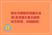 脚关节腱鞘积液图片高清(高清图片展示脚腕关节积液，详细解读)