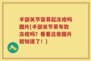 手部关节容易起冻疮吗图片(手部关节易导致冻疮吗？看看这些图片就知道了！)