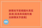 脚踝关节紫癜图片真实高清(高清真实图片展示脚踝关节紫癜)