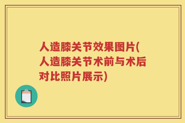 人造膝关节效果图片(人造膝关节术前与术后对比照片展示) 人造膝关节效果图片(人造膝关节术前与术后对比照片展示)