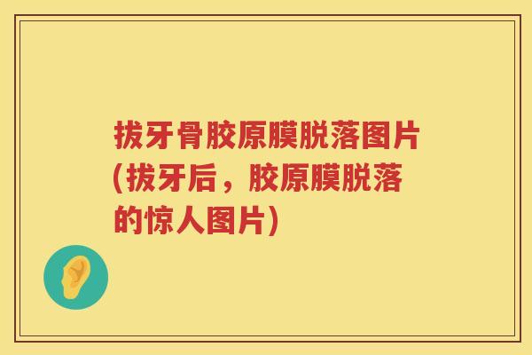 拔牙骨胶原膜脱落图片(拔牙后，胶原膜脱落的惊人图片)